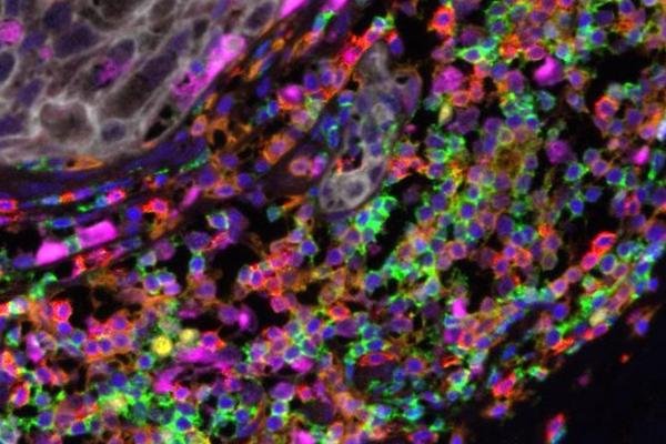 Image for Dynamic Integrative Risk forEcasting to Conquer overTreatment of Ductal Carcinoma In Situ (DIRECT-DCIS)