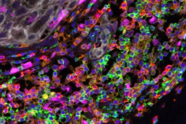 Image for Dynamic Integrative Risk forEcasting to Conquer overTreatment of Ductal Carcinoma In Situ (DIRECT-DCIS)